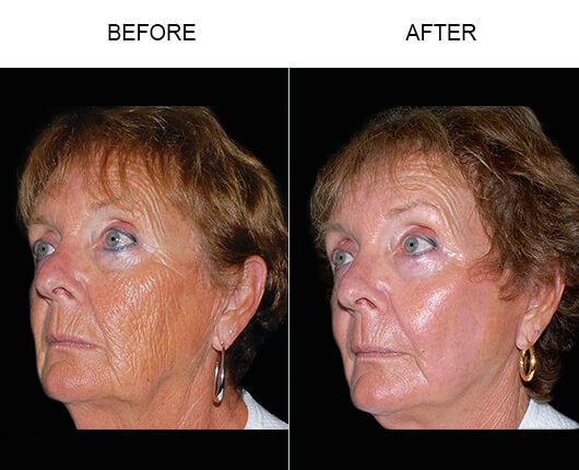 Laser Skin Resurfacing Before And After