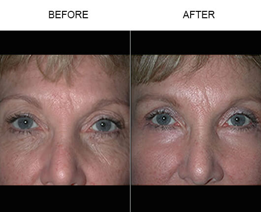 Lower Eyelid Pictures After Surgery 12