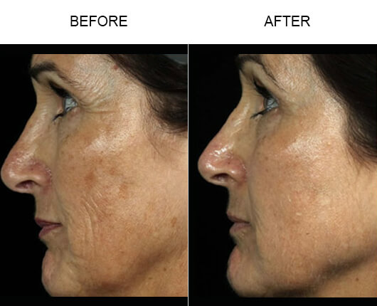 Fraxel Laser Treatment Results Fraxel Laser Treatment Results