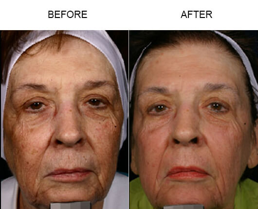 Facial Laser Treatment Results Facial Laser Treatment Results