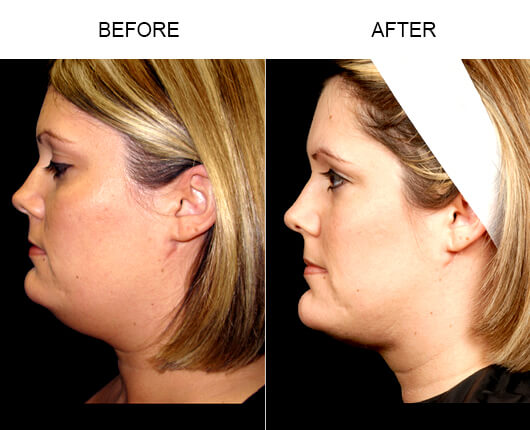 Facial Liposuction Before And After