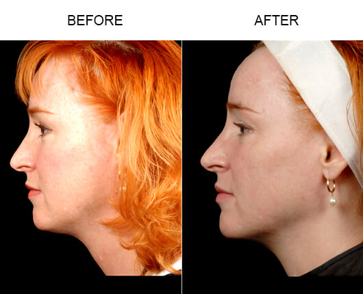 Face Liposuction Before And After