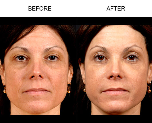 Naturalfill® Facial Filler Before And After Naturalfill® Facial Filler Before And After