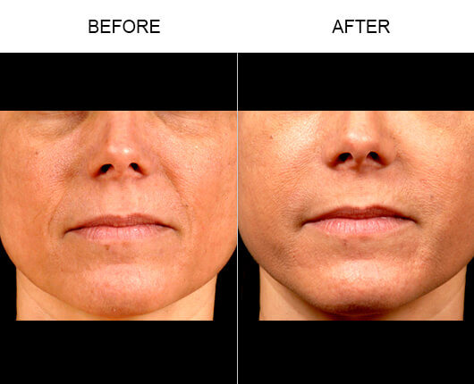 Naturalfill® Before And After Naturalfill® Before And After