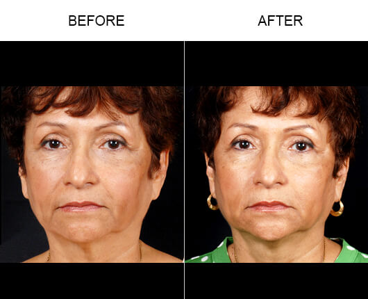 Naturalfill® Results Naturalfill® Results