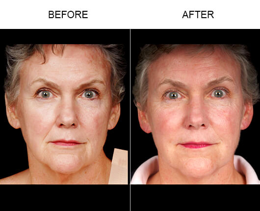Naturalfill® Facial Filler Results Naturalfill® Facial Filler Results