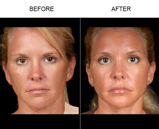 NaturalFill® Face Wrinkle Treatment Results NaturalFill® Face Wrinkle Treatment Results
