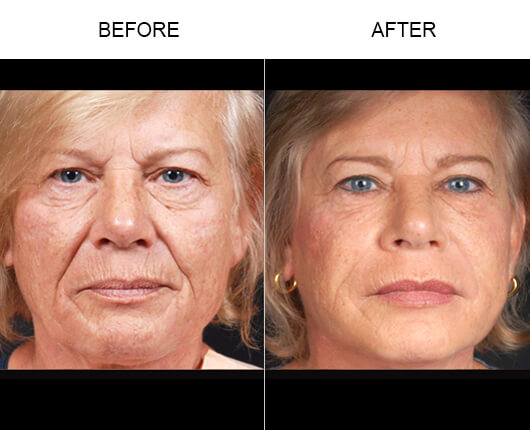 Natural Facial Fillers Before And After Natural Facial Fillers Before And After