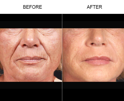 Natural Face Fillers Before And After Natural Face Fillers Before And After