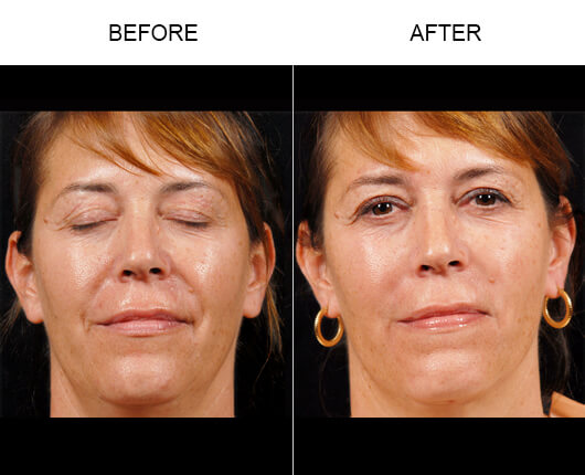 Facial Line Treatment Results Facial Line Treatment Results