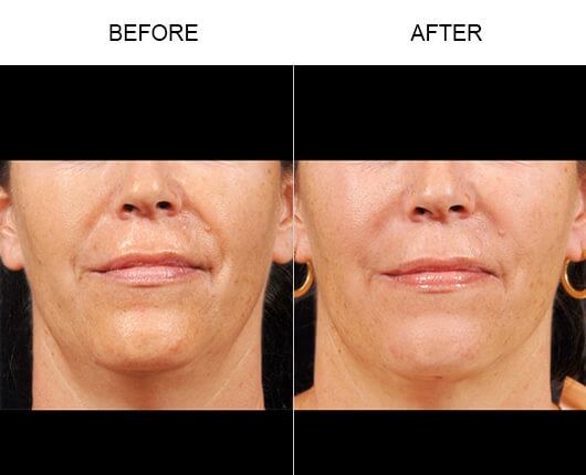Facial Line Treatment Before And After Facial Line Treatment Before And After