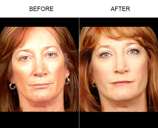NaturalFill® Facial Filler Treatment Results