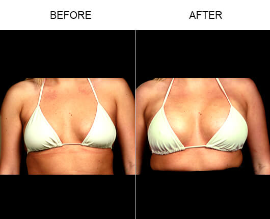 Trussler Plastic Surgery For Breast