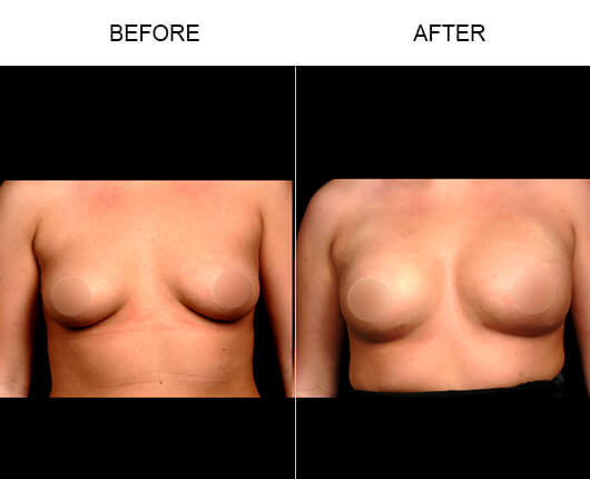 NaturalFill® Natural Breast Enhancement™ Results NaturalFill® Natural Breast Enhancement™ Results