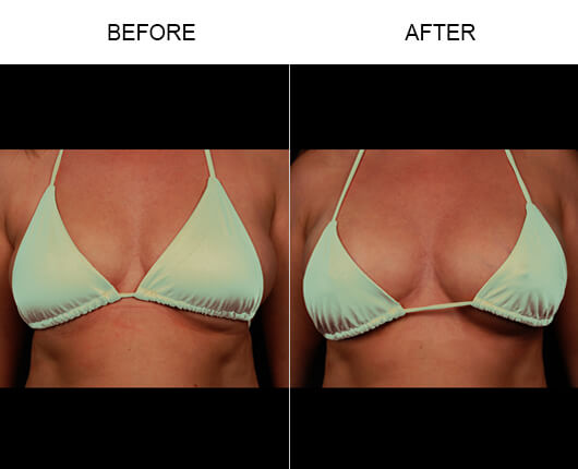 Andrew Trussler Breast Enhancement