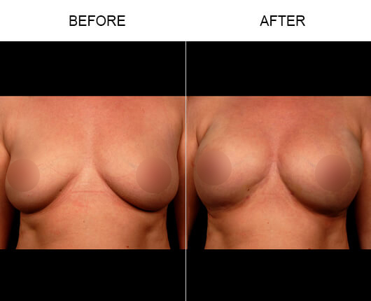 Natural Breast Enhancement Results Natural Breast Enhancement Results