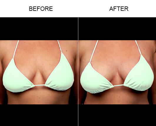 Non-Invasive Breast Enhancement Before And After Non-Invasive Breast Enhancement Before And After