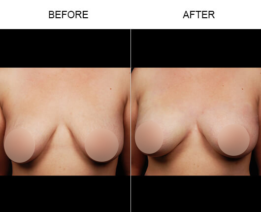 Non-Invasive Breast Enhancement Results Non-Invasive Breast Enhancement Results
