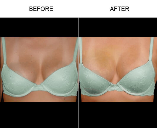 Natural Breast Enlargement Results Natural Breast Enlargement Results