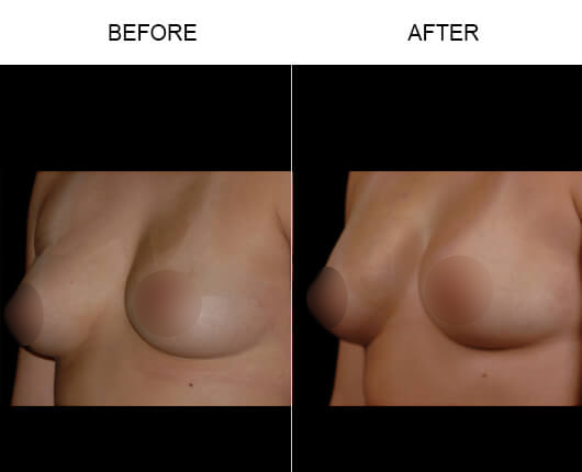 NaturalFill® Breast Enlargement Before And After NaturalFill® Breast Enlargement Before And After