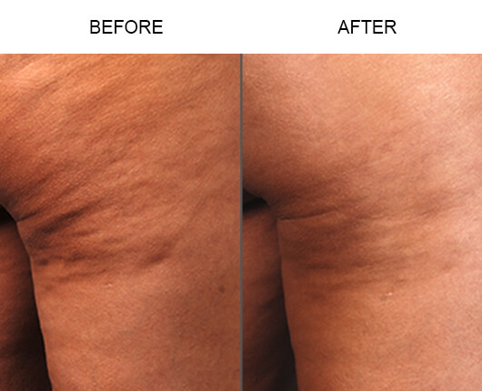 Cellulaze™ Cellulite Treatment Results