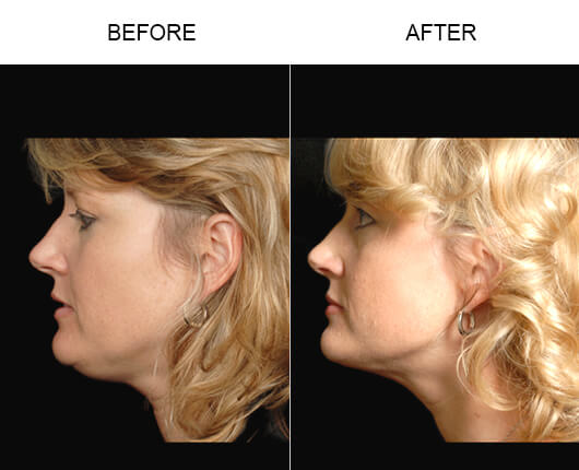 Laser Facelift Results