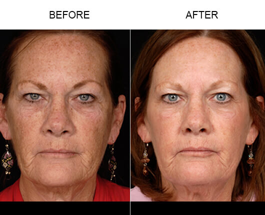 Laser Skin Resurfacing Results