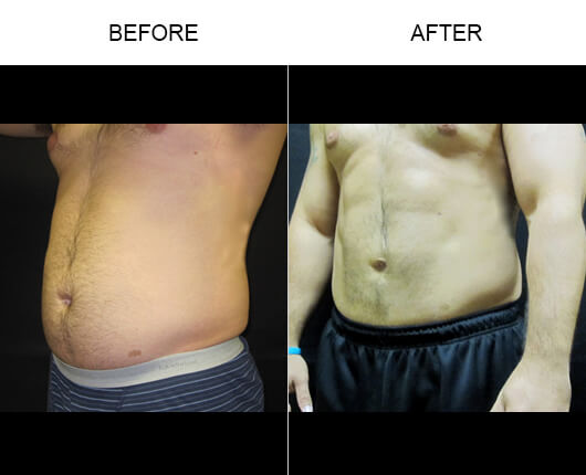 Smartlipo™ Results