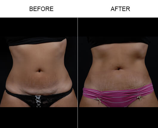 Mini Tummy Tuck Orlando, Abdominoplasty Florida, Body Sculpting Orlando