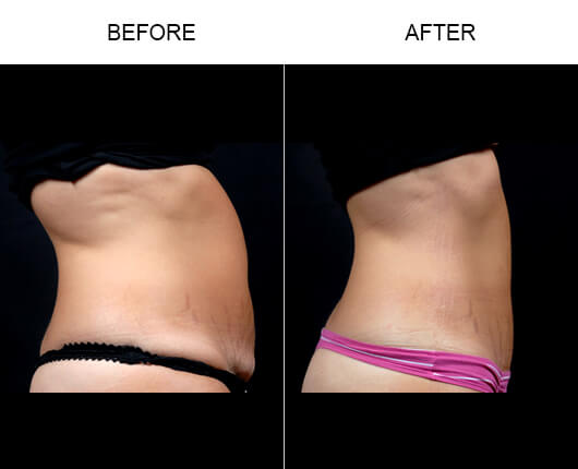 Mini Tummy Tuck Results