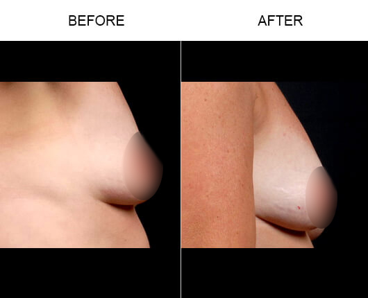 Orlando Natural Breast Enhancement Before and After NaturalFill® Breast Enlargement Results