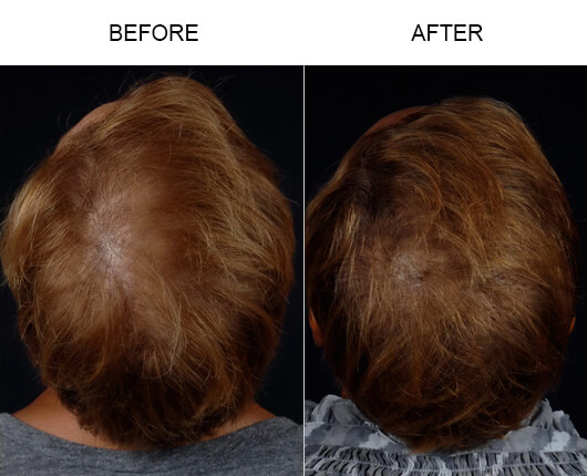 Hair Restoration Before and After