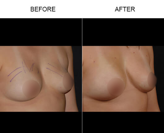 Natural Breast Augmentation Before And After Natural Breast Augmentation Before And After