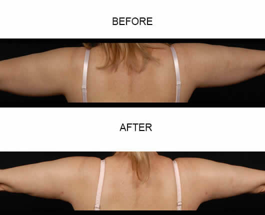 Body Sculpting Results