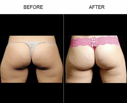 Aqualipo® Body Sculpting Results