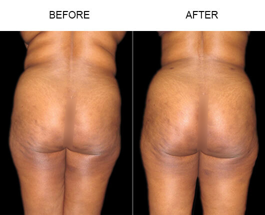 Natural Buttocks Enhancement Results Natural Buttocks Enhancement Results
