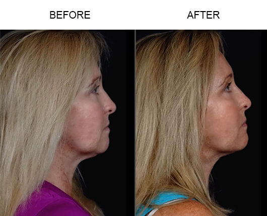 Laser Facelift Procedure Before And After Laser Facelift Procedure Before And After