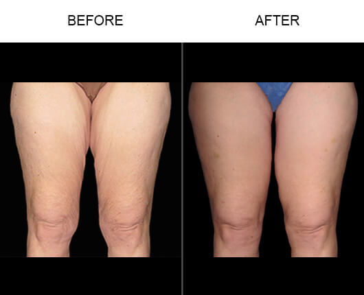 Thigh Lift Before And After
