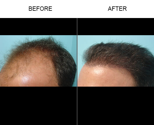 Hair Transplant Before and After