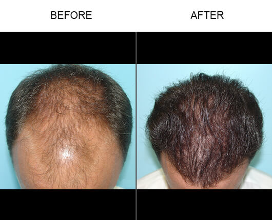 Hair Restoration Florida Before and After