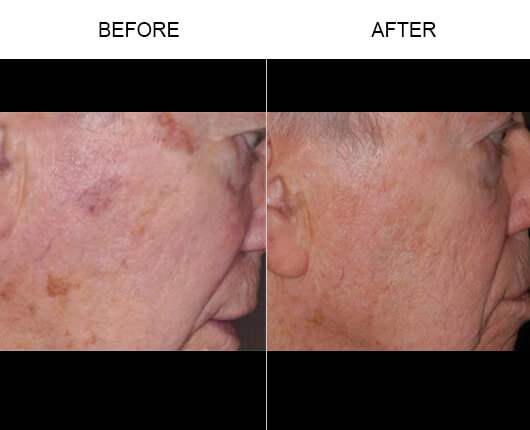Laser Vein Removal Before And After
