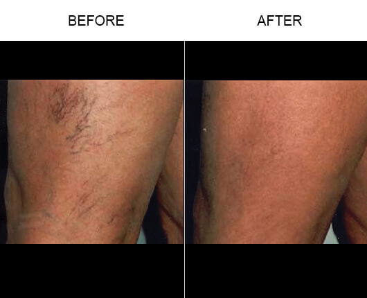 Laser Vein Removal Results