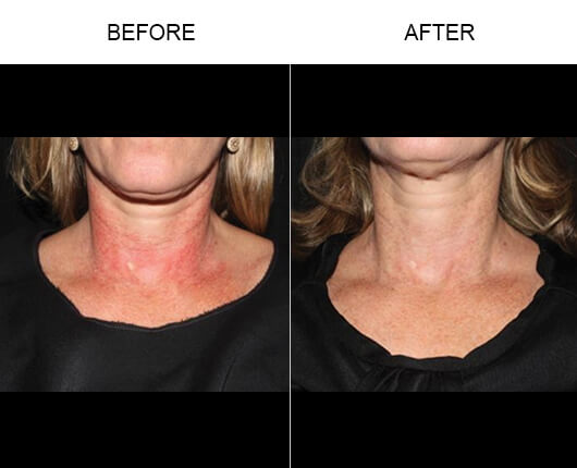 Vein Treatment Before And After