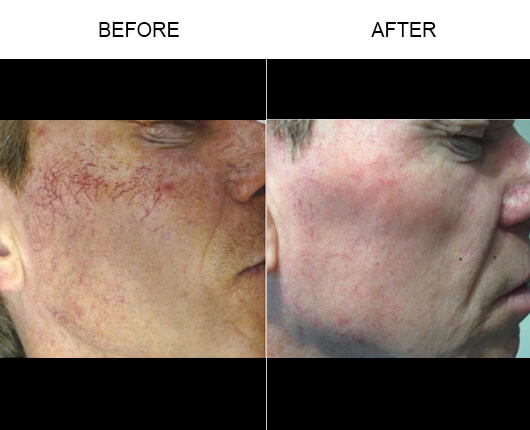 Vein Removal Before And After Vein Removal Before And After