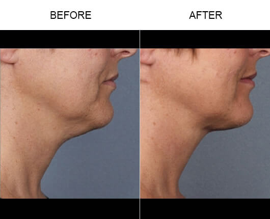 Kybella™ Results