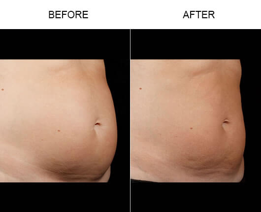 Laser Fat Removal Before & After