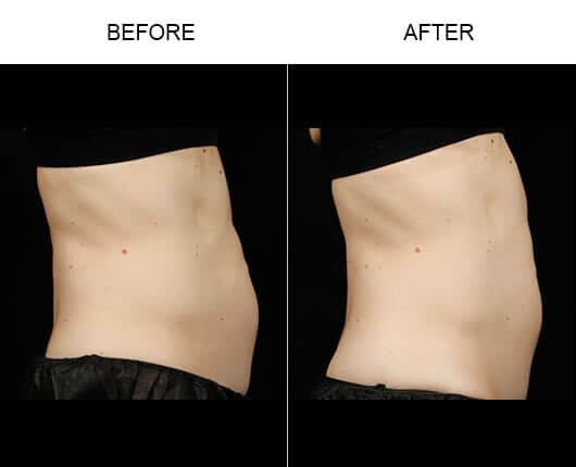 Laser Fat Remover 20