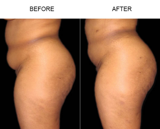 Natural Buttocks Enhancement Results Before And After Natural Buttocks Enhancement Results Before And After