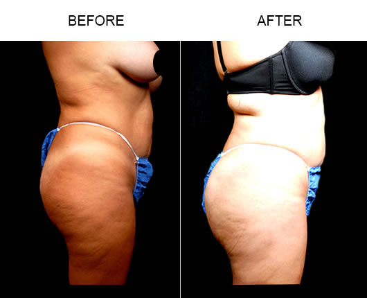 Naturalfill® Buttocks Enhancement Results