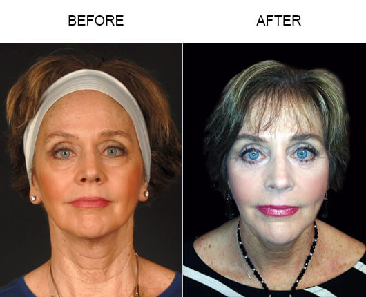LazerLift® Results LazerLift® Results